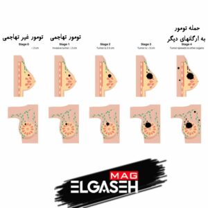 مراحل پیشرفت سرطان سینه از بروز تومور غیر تهاجمی تا تومور تهاجمی و حمله تومور به سایر ارگان های مجاور سینه