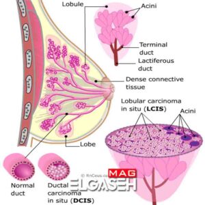 علائم سرطان سینه گاهی در افرادی که قبلا کارسینوم مجرای درجا DCIS داسته اند خودر را نشان میدهد