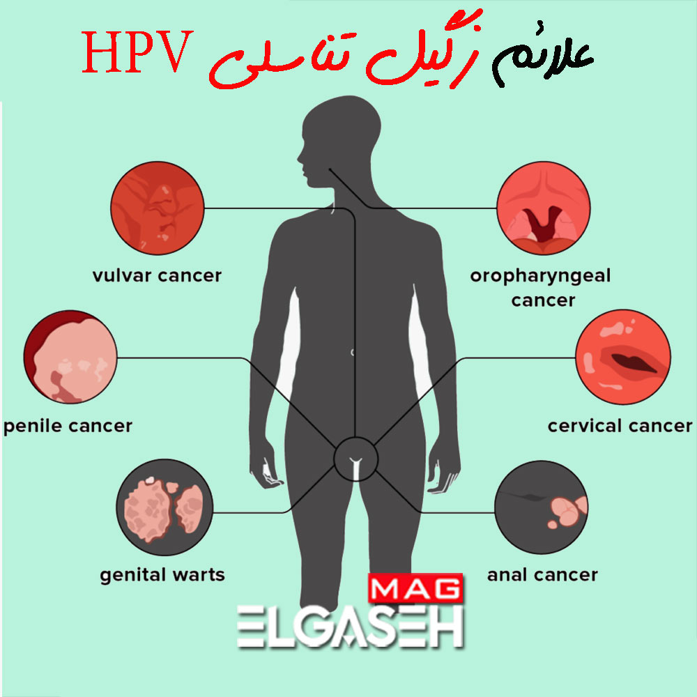 بیماری های مقاربتی مثل زگیل تناسلی دارای علائمی مثل زائده هایی گوشتی و زگیل مانند در اطراف آلت تناسلی یا مقعد هست